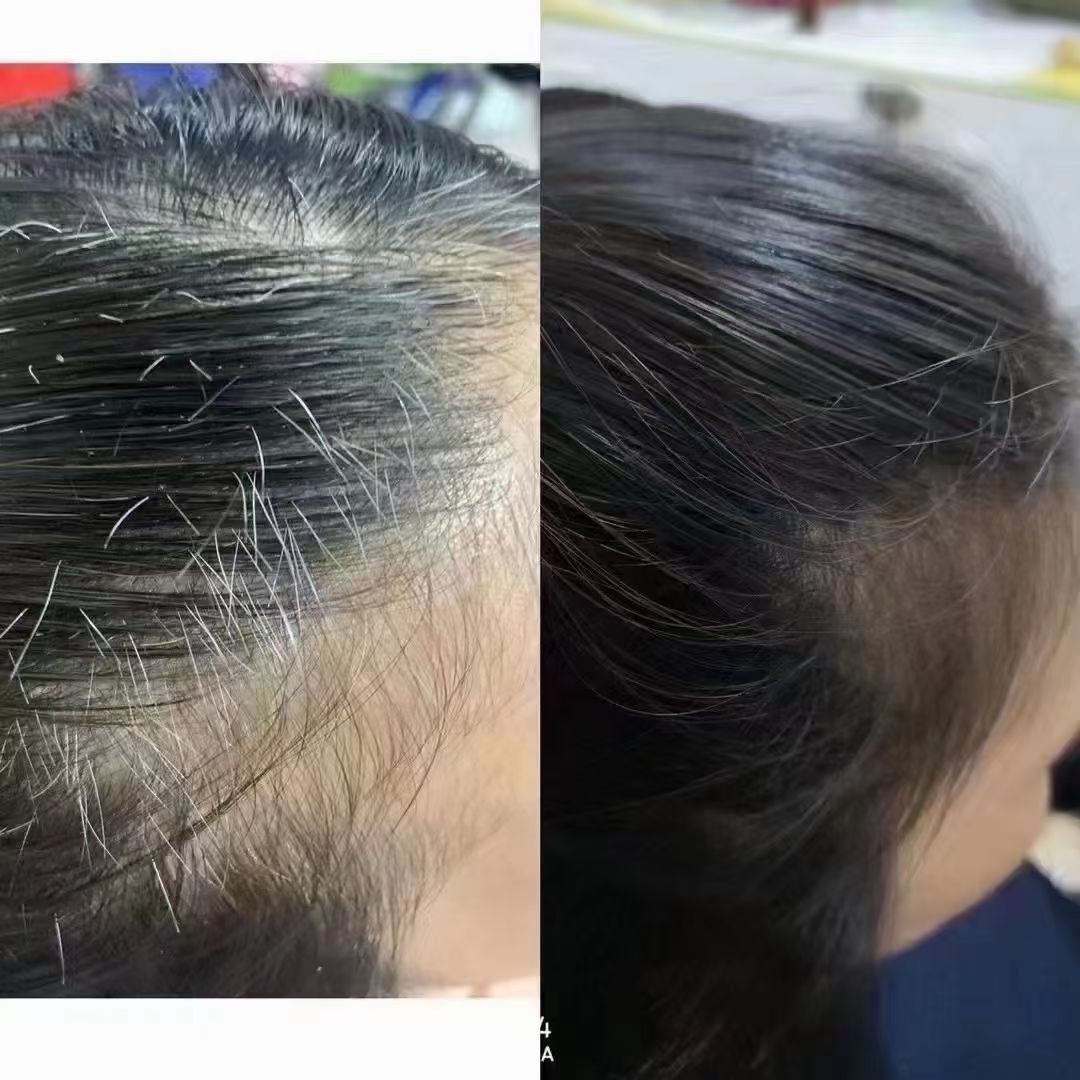 前额顶区白发调理前后对比：左图黑发中夹生粗硬白发，右图白发减少、黑发顺滑贴合