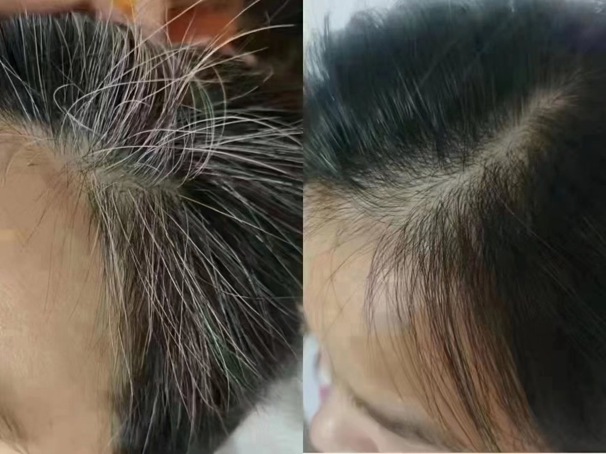 前额发际线白发调理前后对比：左图发际线边缘白发密集、头皮可见，右图长出黑色新发、边缘不再灰白